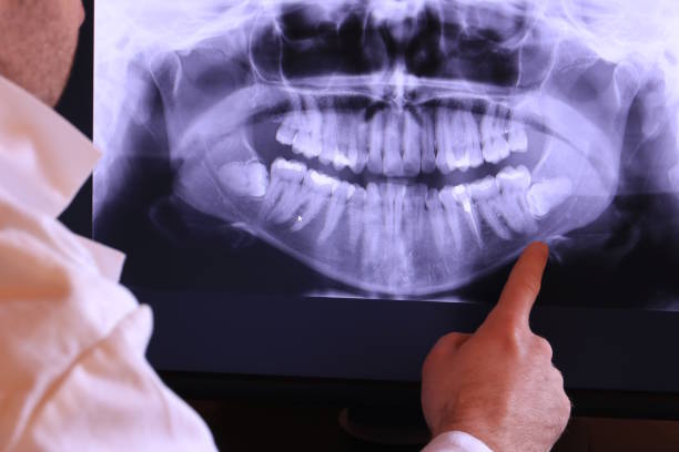 Best Emergency Treatment for Dental Infections or Abscesses in Milledgeville, GA